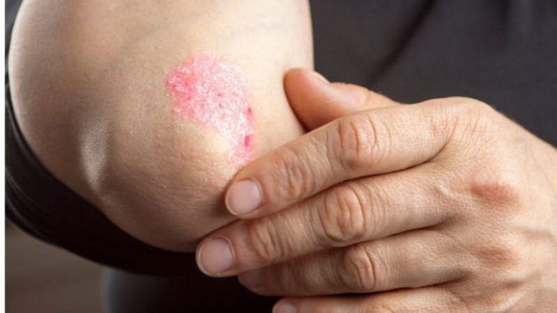 Psoriasis, Its Causes, Triggers, Symptoms and Types