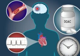 Early Anticoagulation in Severe Stroke with AF: Experts Weigh In