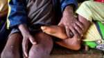 Central African Republic declared Mpox outbreak
