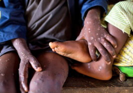 Central African Republic declared Mpox outbreak