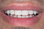 Risks and Dangers of using cheap veneers