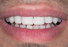 Risks and Dangers of using cheap veneers