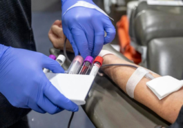 Iron Deficiency Affects 1 in 3 U.S. Adults: Study