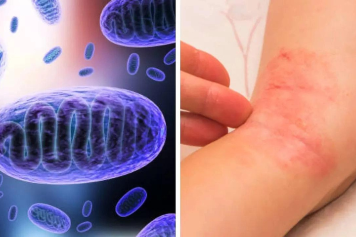 Fungal Infections Evolve into Silent Pandemic