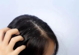 How to Get Rid of Dandruff From Hair?