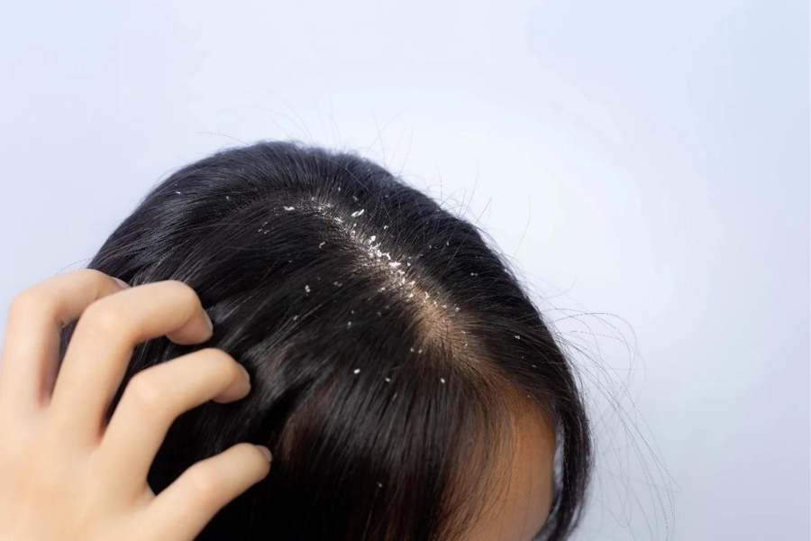 How to Get Rid of Dandruff From Hair?