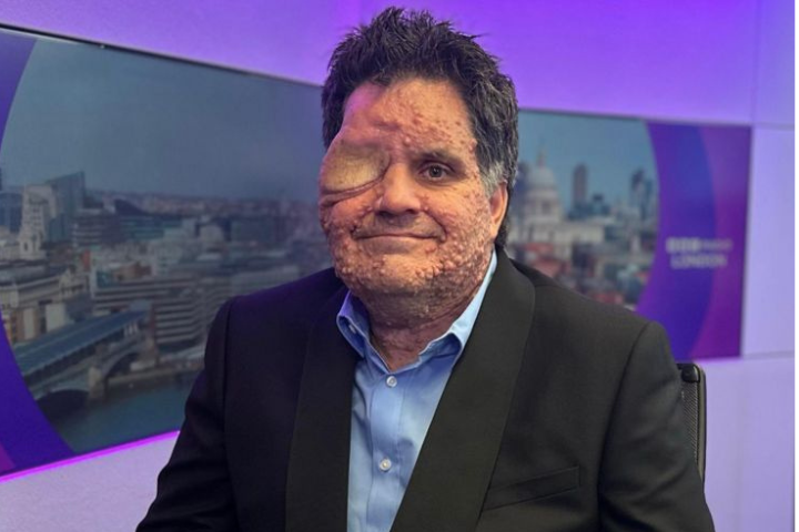 Man With Facial Disfigurement Asked To Leave Restaurant