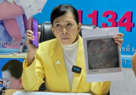 Woman Endures 18 Years of Pain from Forgotten Needle