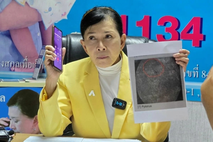 Woman Endures 18 Years of Pain from Forgotten Needle